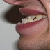Phương pháp niềng răng móm