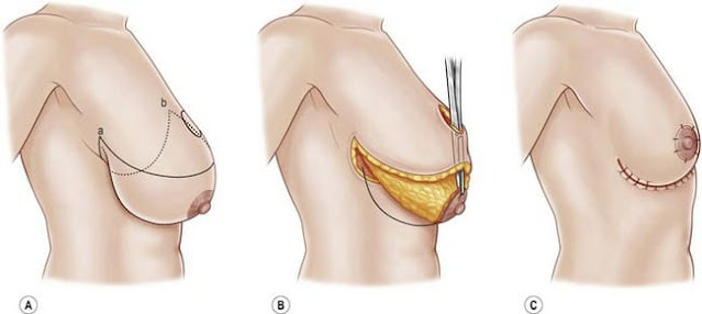 Hypertrophie mammaire : quand une réduction mammaire est-elle nécessaire ?