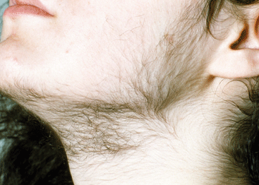 hair-growth on face It also allows removing of hair-growth on face and other body-parts, a condition identified as Hirsutism that is an obvious manifestation of Polycystic Ovarian Symptoms.