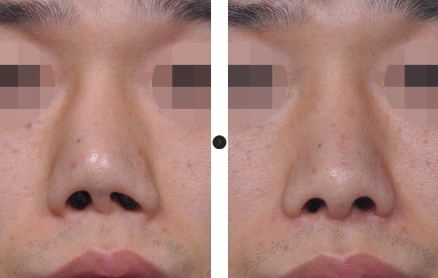 Curved Nose Meaning at Beulah Jones blog