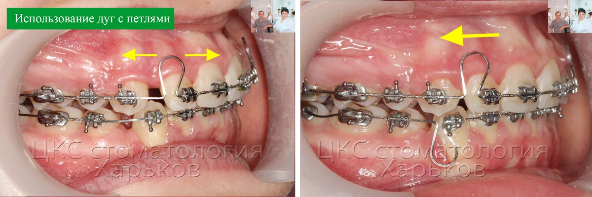 О стоматологии и не только...: Что такое брекет система и как она ...