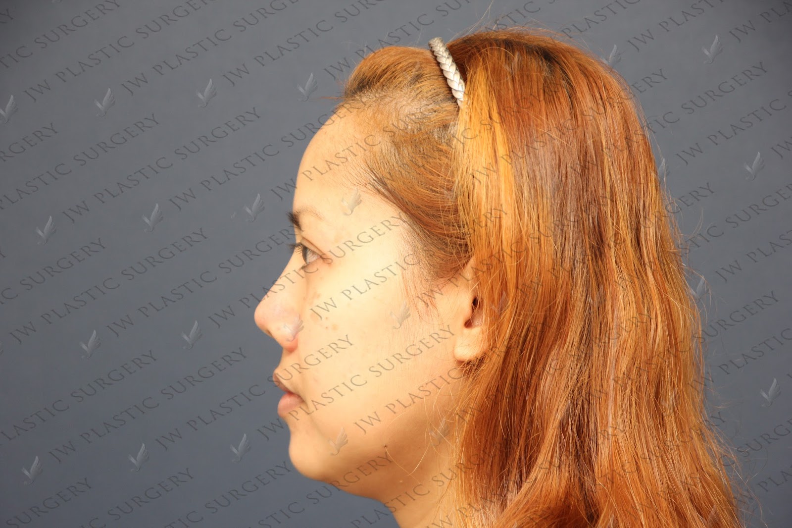 Face Lift By Made Double Eyelid Incision Accusculpt Lift Jowlneck