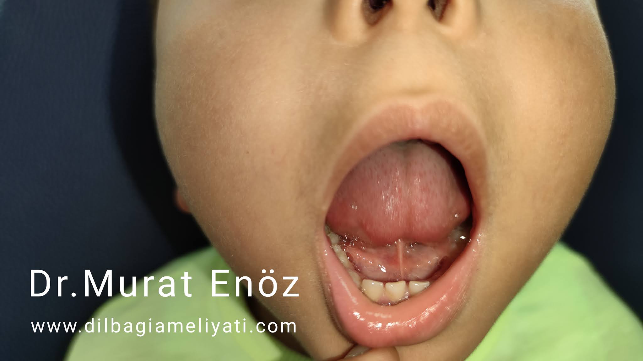 dil bagi belirtileri tanisi ve tedavisi 2021 guncellendi