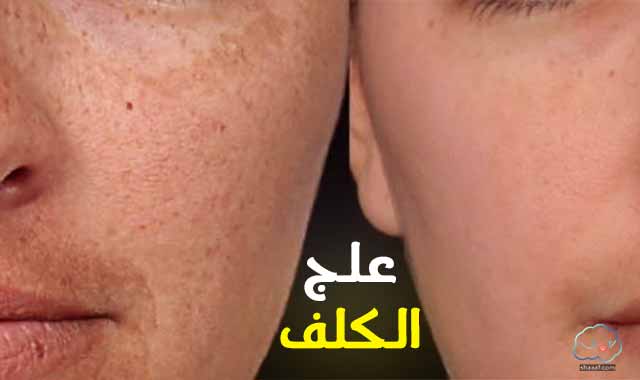 تقشير الكلف في البيت | وصفات طبيعية والكريمات