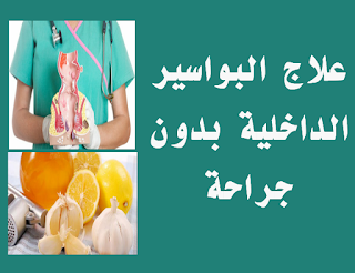 علاج البواسير الداخلية بدون جراحة البواسير الداخلية