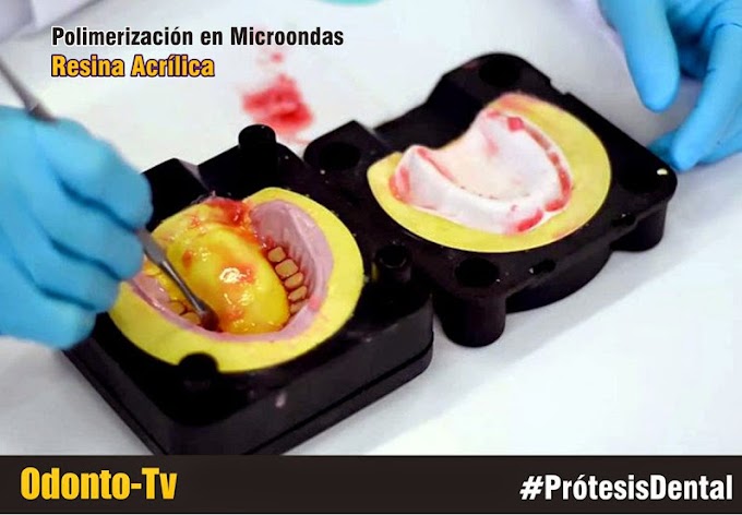 LABORATORIO DENTAL: Resina acrílica - técnica de polimerización por microondas