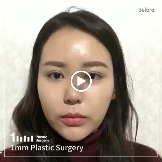 See how her face changed~! (rhinoplasty)
