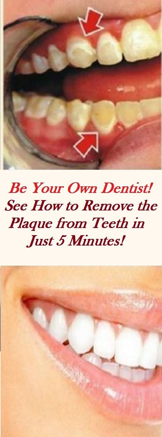 Be Your Own Dentist! See How To Remove The Plaque From Teeth In Just 5