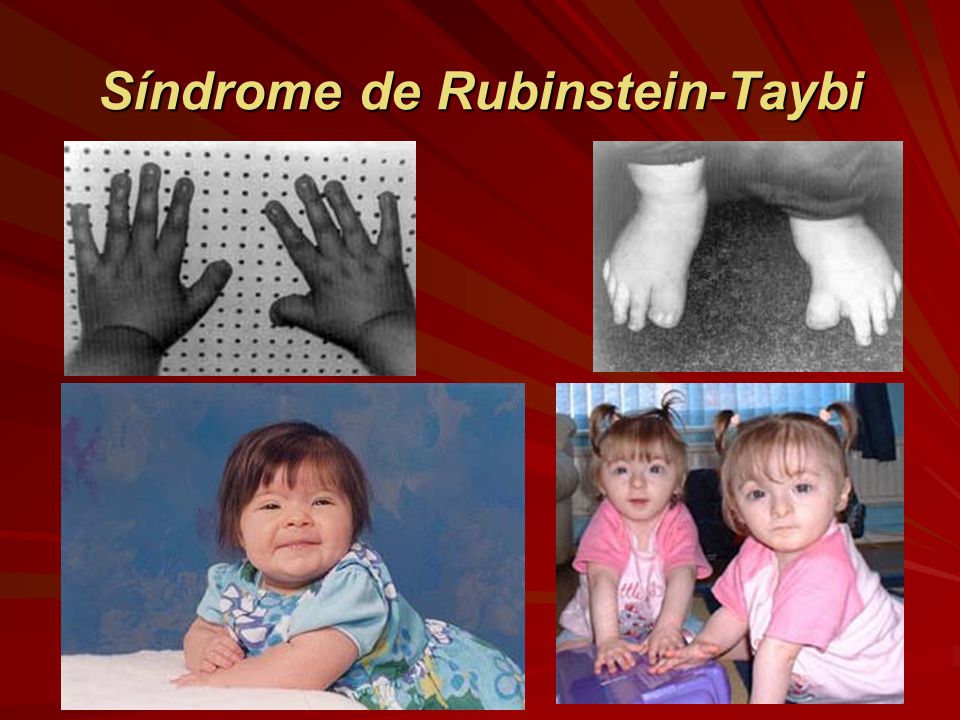 Guapimirim News: CRIANÇAS ESPECIAIS 12 - Síndrome de Rubinstein-Taybi