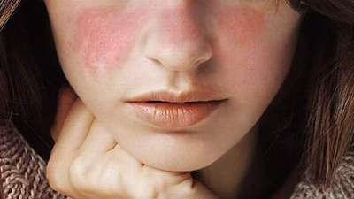 Bệnh lupus là gì và triệu chứng bệnh lupus?