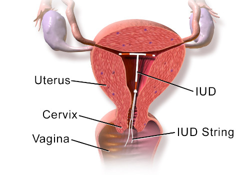  IUD (Intrauterin Device)