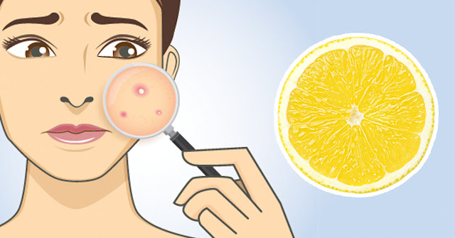 Remove Scars And Acne Marks Just With Lemon