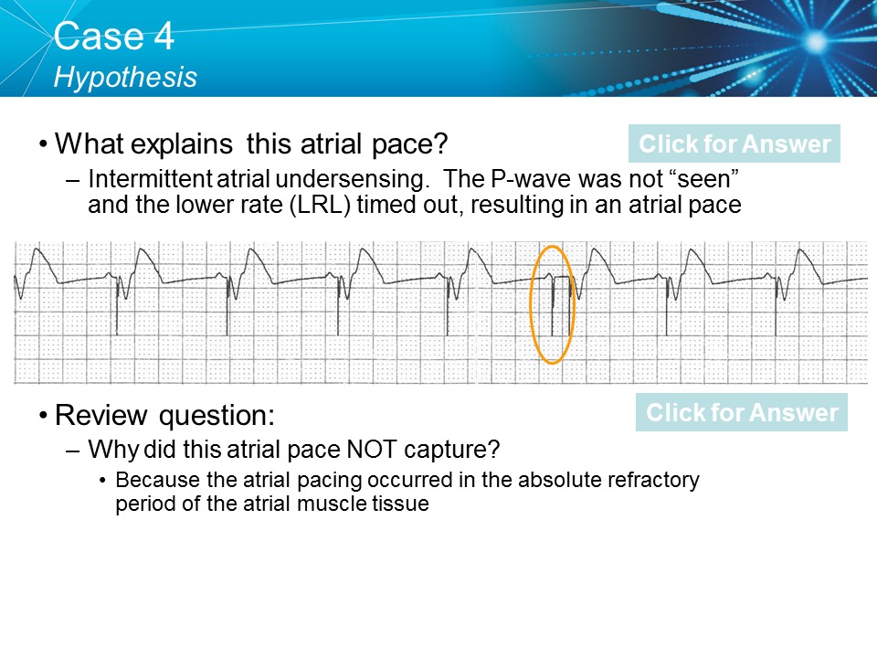 CVT Mohd Farid: Basic Pacemaker Troubleshooting Part I-Medtronic Academy