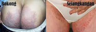 Cara Obat gatal di bokong