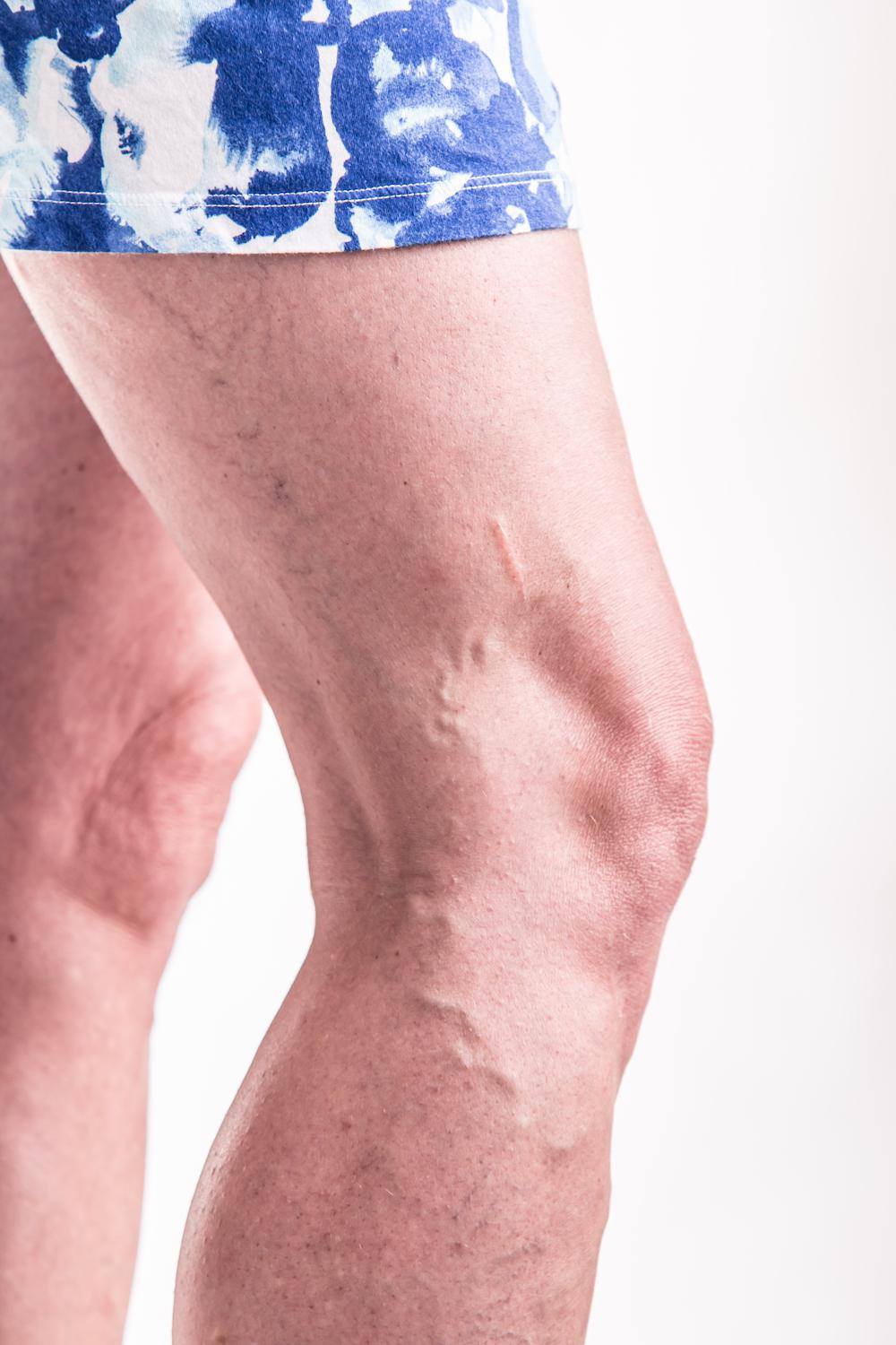 cum se efectueaza operaia varicoasa perna ortopedica pentru picior varicoza