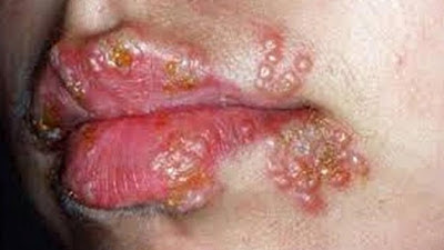 Obat Tradisional Herpes pada Mulut Anak