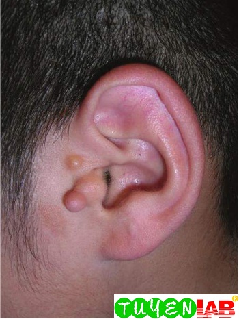 [Pediatric] Atlas of Preauricular tags | Free Medical Atlas