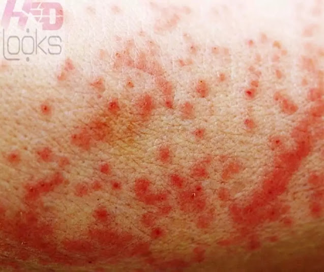 hiv rash pictures hiv rash pictures