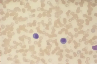 pancytopenia visceral leishmaniasis marrow leishman noted