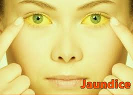 Jaundice Symptoms and Causes