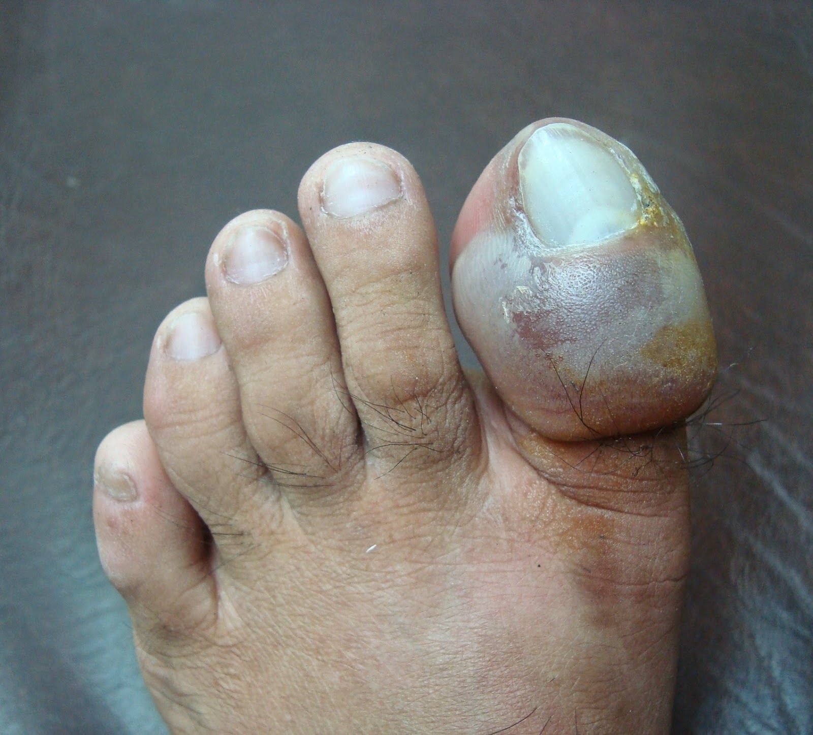 Self Take care of Ingrown Toenail : Nail Treatment Center