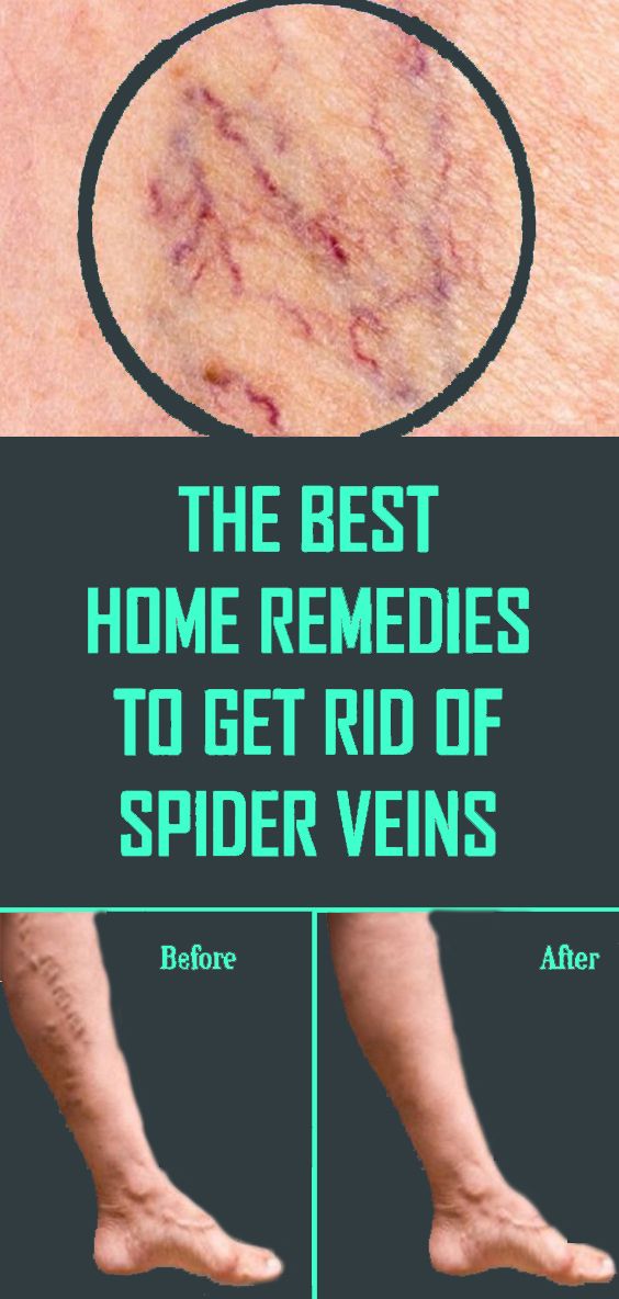 Get Rid Of Spider Veins In These 7 Natural Methods info remedies