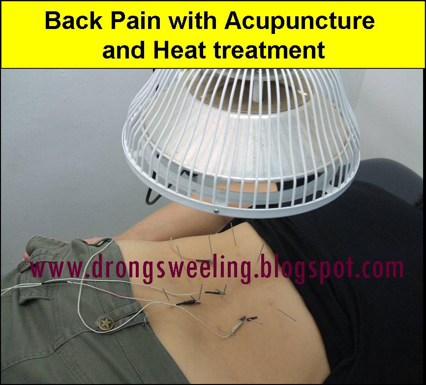 TCM News TCM Physician Treatment for Back Pain LumboSacral Spondylosis