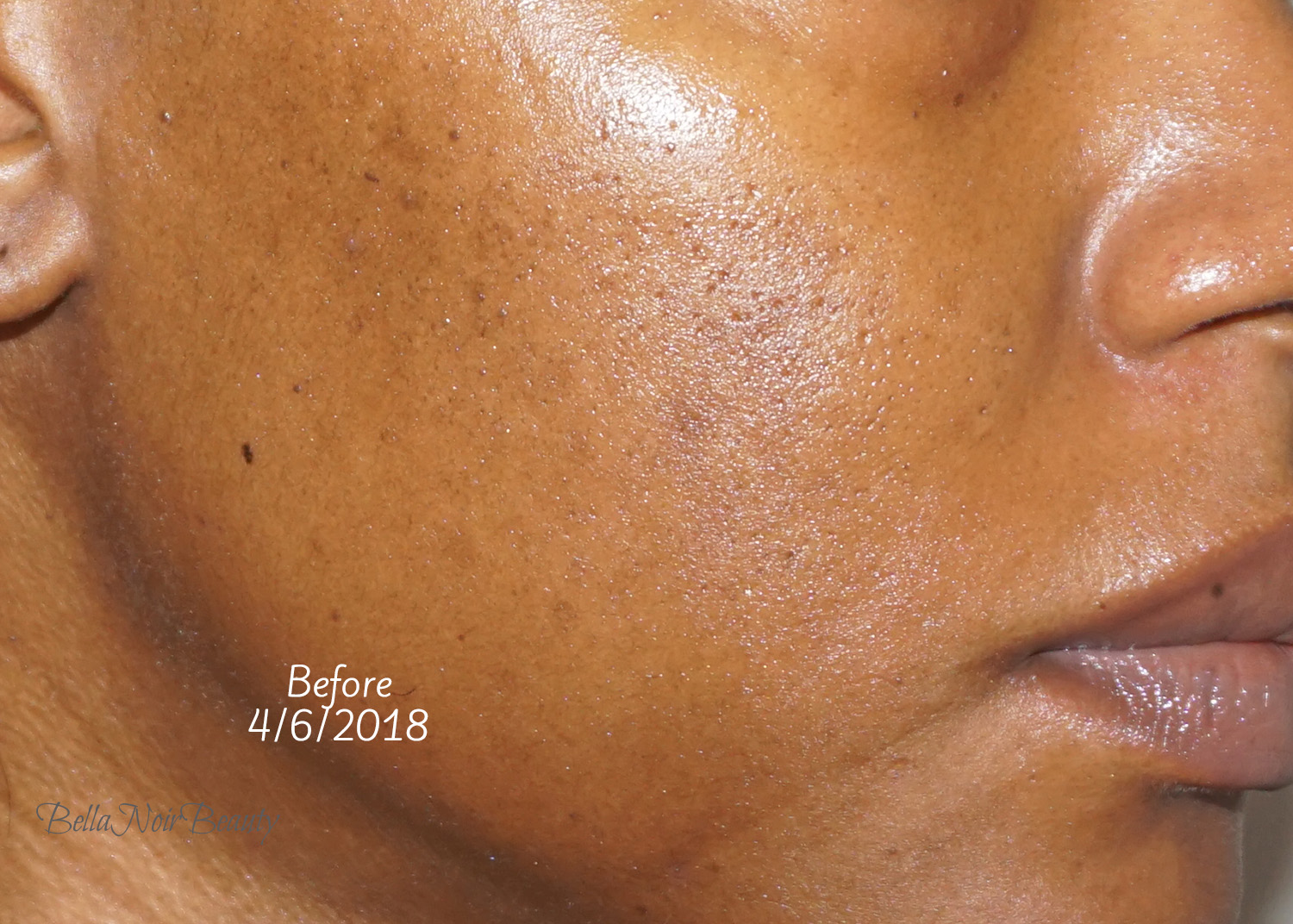 Review Here's What The Ordinary Mandelic Acid 10 Did to My Skin