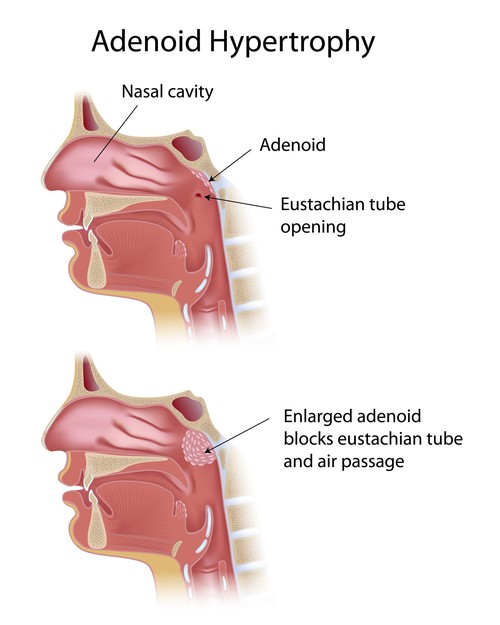 Adenoiditis and Adenoid Hypertrophy Vikram ENT Hospital & Research