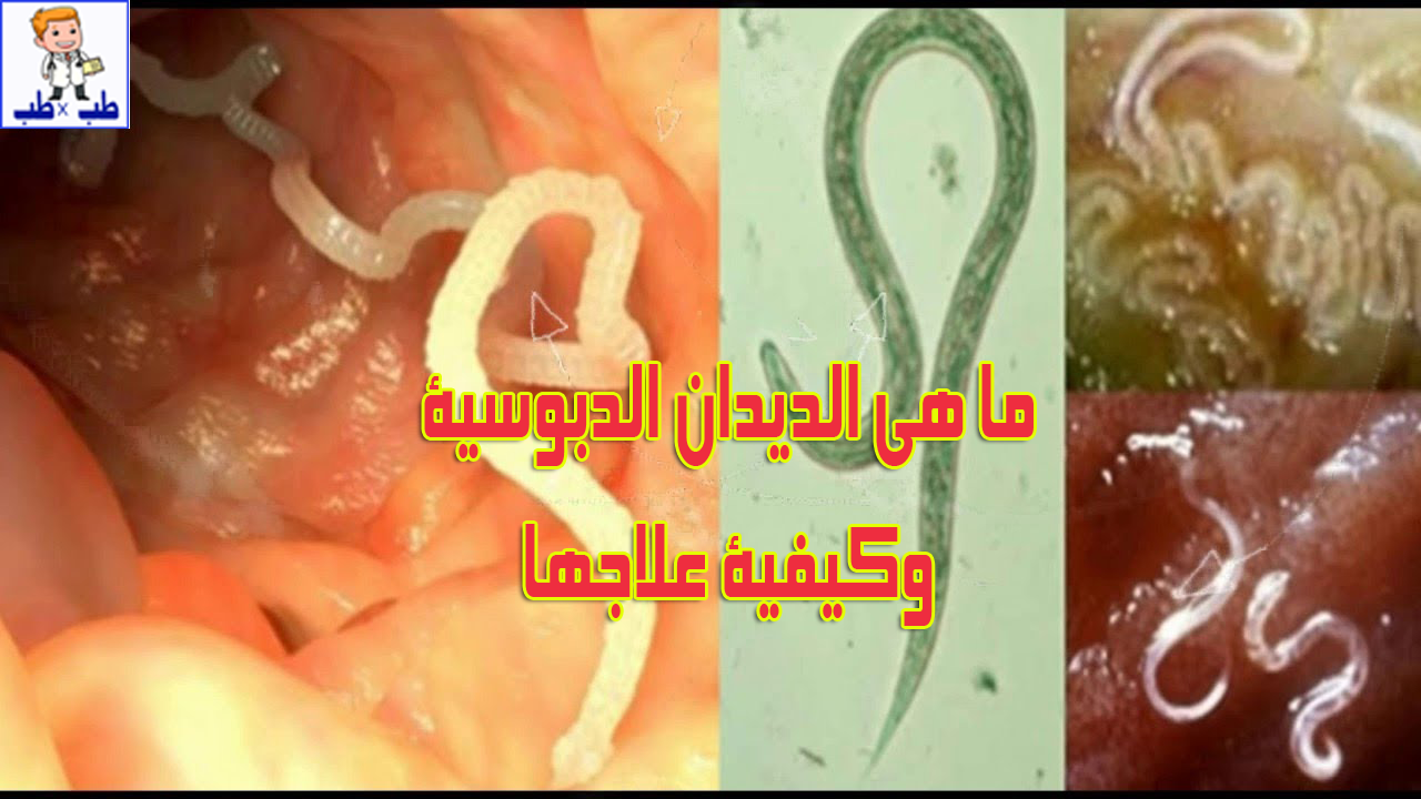 ما هي الديدان الدبوسية و كيفية علاجها طب فى طب