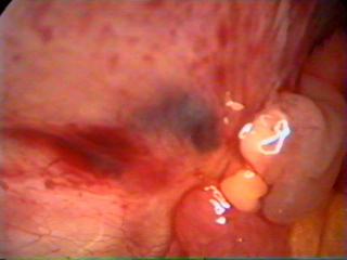 Endomtriosis of pelvic peritoneum-Laparoscopy done by Dr. Alaa Mosbah