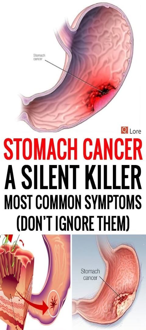 Stomach Cancer A Silent Killer Most Common Symptoms Dont Ignore