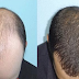 How To Stop Baldness, Hair Loss And Hair Fall With Only 1 Solution Using Home Remedies