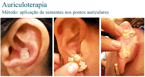 acupuncture de l'oreille acupuncture auriculaire chinoise ear acupuncture Ear acupuncture Chinese 耳针耳针黄李春中国 oreja acupuntura del oído de la acupuntura china Huang Li Chun acupuntura auricular auriculoterapia chinesa acupuntura Huang Li Chun acupuncture de l'oreille acupuncture auriculaire chinoise ear acupuncture Ear acupuncture Chinese 耳针耳针黄李春中国 oreja acupuntura del oído de la acupuntura china Huang Li Chun acupuntura auricular auriculoterapia chinesa acupuntura Huang Li Chun