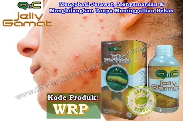 Obat Jerawat Paling Bagus, Ampuh Mengobati Jerawat Batu & Jerawat Pasir Obat Jerawat Paling Bagus, Ampuh Mengobati Jerawat Batu & Jerawat Pasir