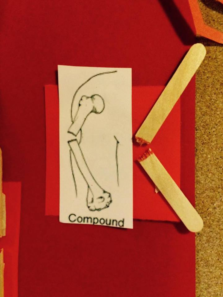 Tales of the 10th West Irregulars: types of fractures, human anatomy