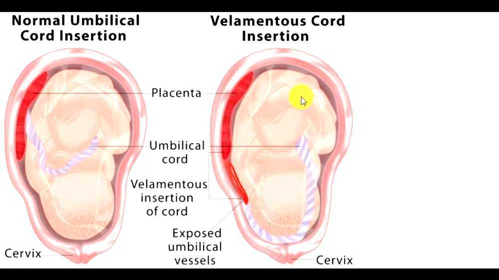 Velamentous cord insertion