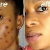 How To Quickly Eliminate Pimples At Home