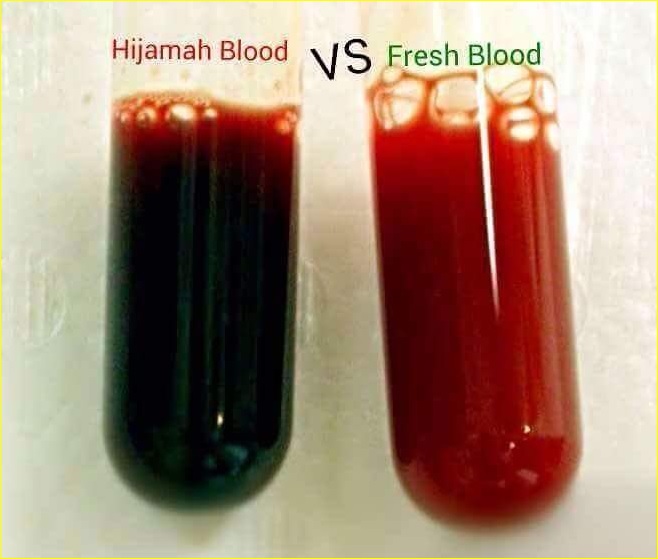 Bekam Bukit Mertajam (Hijamah): BEKAM DARAH KOTOR