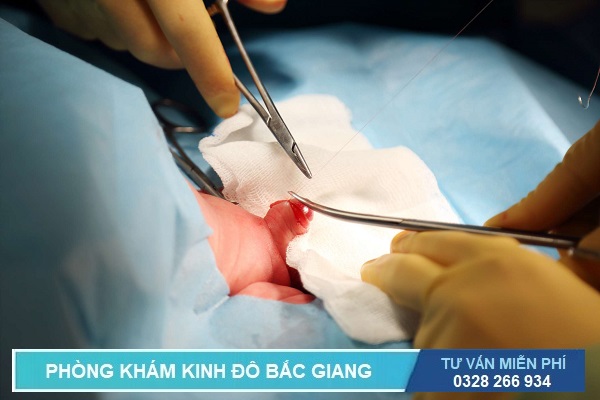 Cắt bao quy đầu ở Bắc Giang 