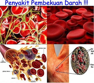 Hasil gambar untuk Obat Pembekuan Darah Di Otak