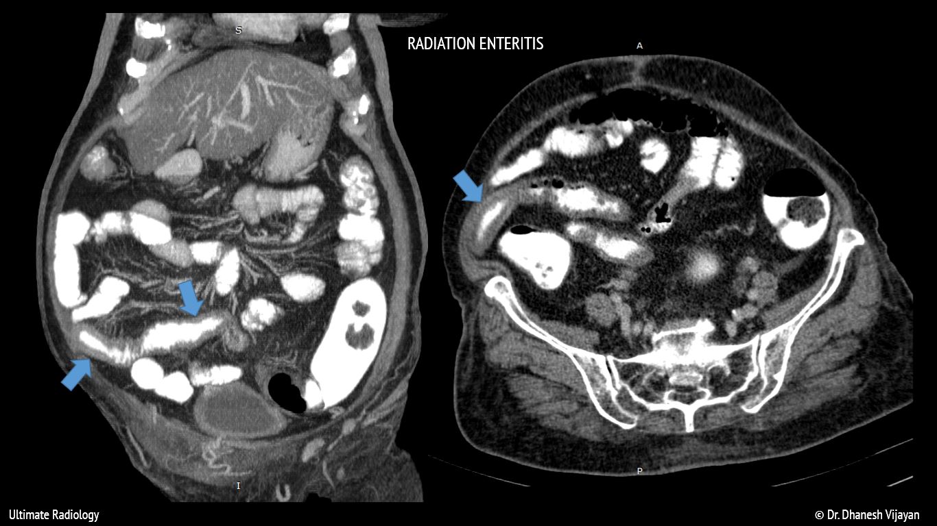 Ultimate Radiology Radiation enteritis