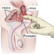 prostatita acută netratată