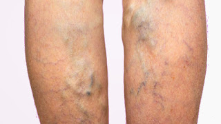 How to Prevent Varicose Veins During Pregnancy
