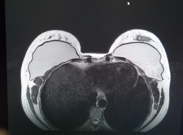 mri of breast implant vintage chophouse and tavern