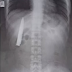 Doctor found knife stuck on man's chest for more than a year