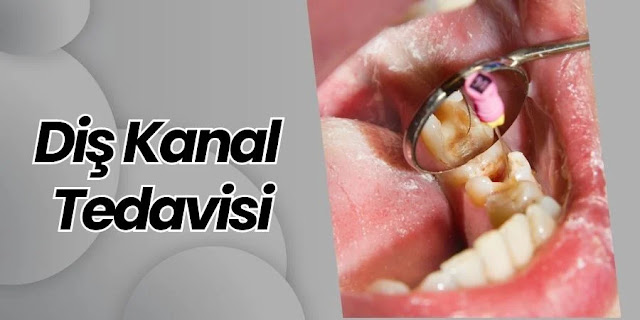 Diş Kanal Tedavisi - Diş Doktoru