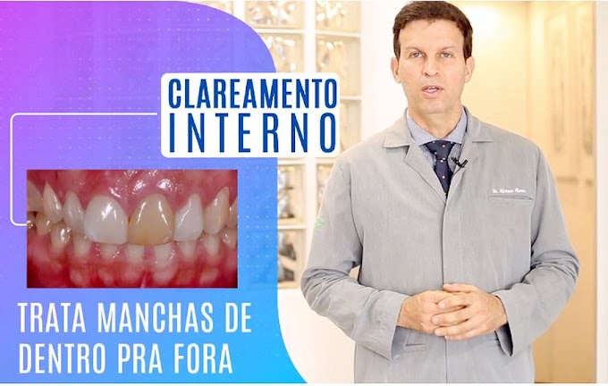 CLAREAMENTO DE DENTES: como ter dentes mais brancos com o dentista - Dr. Adriano Abreu