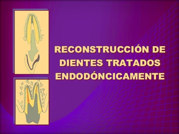 ENDODONCIA: Reconstrucción Intrarradicular - Videoconferencia del Mtro. Enrique Ríos Szalay