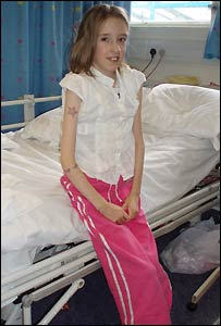 Marfan Syndrome: This is a girl with Marfan Syndrome